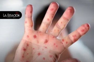 Nueva variante de Viruela Símica detectada en Ecuador