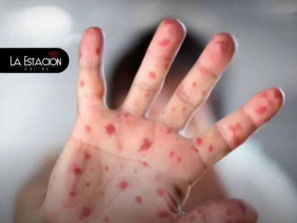 Nueva variante de Viruela Símica detectada en Ecuador